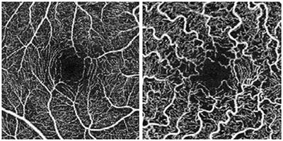 Optical Coherence Tomography Angiography for the Evaluation of Retinal Vasculature in Fabry Disease: Our Experience and Review of Current Knowledge